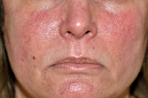 Laser Procedures Before