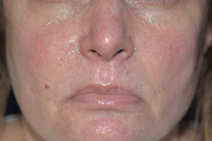 Laser Procedures After