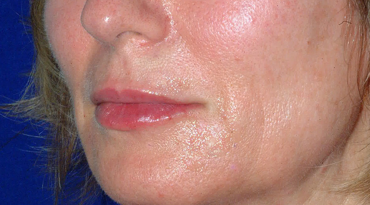 After lip enhancement