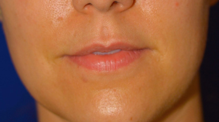 Before lip enhancement