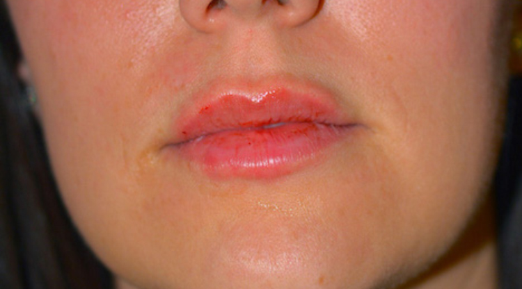 After lip enhancement