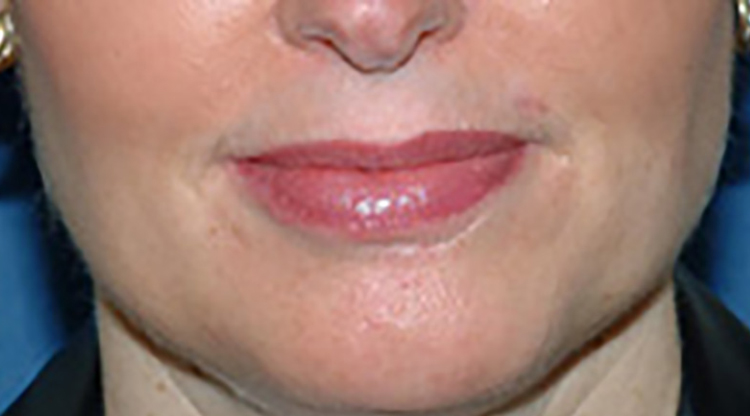 After Dermal Fillers