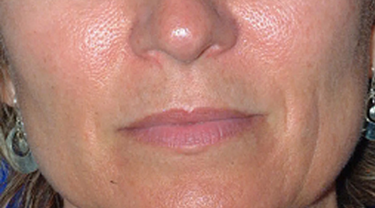 Advanced Dermal Fillers