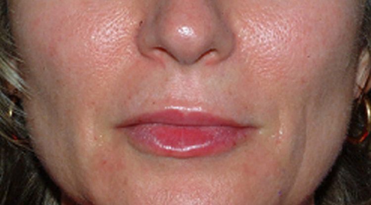 After Advanced Dermal Fillers