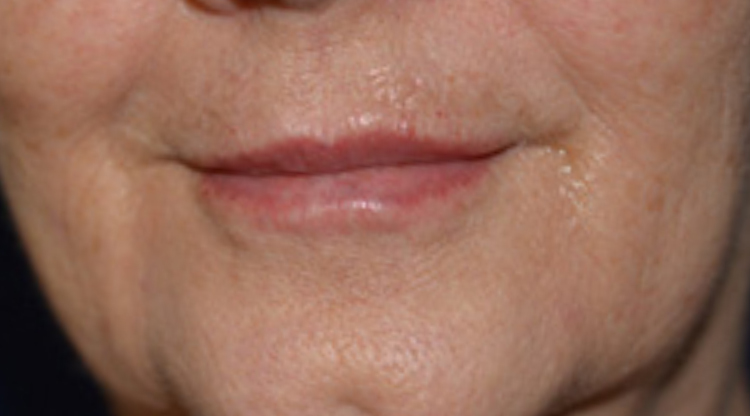 After Dermal Fillers