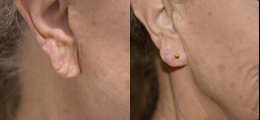 Restylane® Before and After | New Albany IN, St. Matthews KY