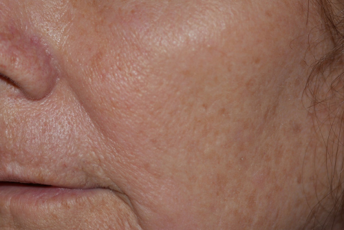 Before fractional laser skin resurfacing