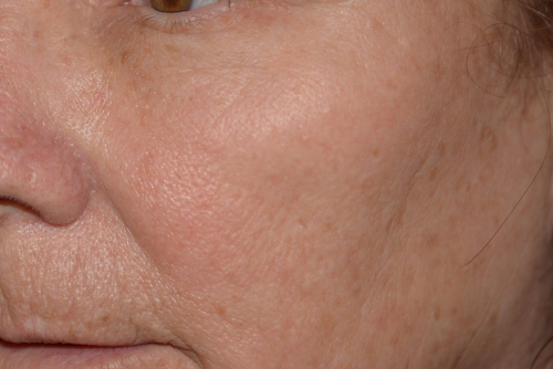 After fractional laser skin resurfacing
