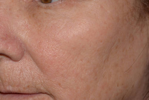 After fractional laser skin resurfacing