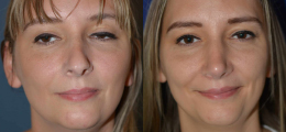 Nose Reshaping Before and After | New Albany IN, St. Matthews KY