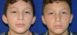 Ear Reshaping Before and After | New Albany IN, St. Matthews KY