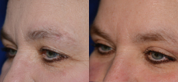 Eyelid Lift Before and After | New Albany IN, St. Matthews KY