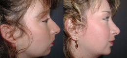 Chin Augmentation Before and After | New Albany IN, St. Matthews KY