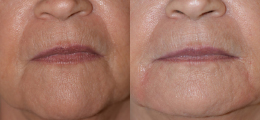 Restylane® Before and After | New Albany IN, St. Matthews KY