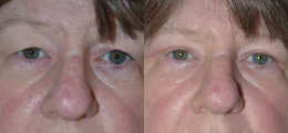 Eyelid Lift Before and After | New Albany IN, St. Matthews KY