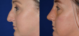 Nose Reshaping Before and After | New Albany IN, St. Matthews KY