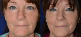Facelift Before and After | New Albany IN, St. Matthews KY