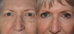 Eyelid Lift Before and After | New Albany IN, St. Matthews KY