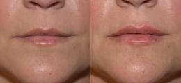 Lip Enhancement Before and After | New Albany IN, St. Matthews KY