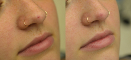 Laser Procedures Before and After | New Albany IN, St. Matthews KY