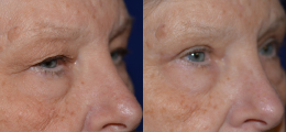 Eyelid Lift Before and After | New Albany IN, St. Matthews KY