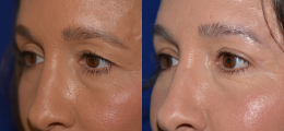 Eyelid Lift Before and After | New Albany IN, St. Matthews KY