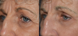 Eyelid Lift Before and After | New Albany IN, St. Matthews KY