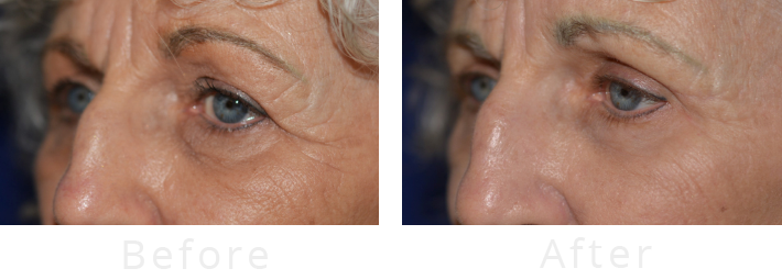 Before and After Refresh Your Look with In-Office Upper Eyelid Surgery