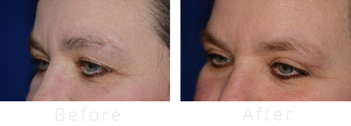 Before and After Refresh Your Look with In-Office Upper Eyelid Surgery
