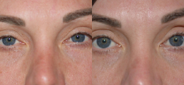 Chemical Peel Before and After | Ne