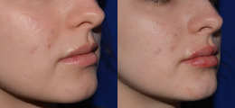 Lip Enhancement Before and After | New Albany IN, St. Matthews KY