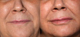 Lip Enhancement Before and After | New Albany IN, St. Matthews KY