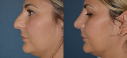 Nose Reshaping Before and After | New Albany IN, St. Matthews KY
