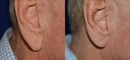 Ear Reshaping Before and After | New Albany IN, St. Matthews KY