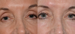 Chemical Peel Before and After | New Albany IN, St. Matthews KY