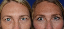 Eyelid Lift Before and After | New Albany IN, St. Matthews KY