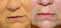 Laser Procedures Before and After | New Albany IN, St. Matthews KY
