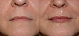Lip Enhancement Before and After | New Albany IN, St. Matthews KY