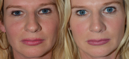 Nose Reshaping Before and After | New Albany IN, St. Matthews KY
