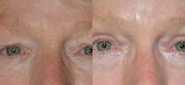 Eyelid Lift Before and After | New Albany IN, St. Matthews KY