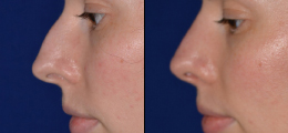 Nose Reshaping Before and After | New Albany IN, St. Matthews KY