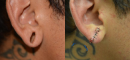 Ear Reshaping Before and After | New Albany IN, St. Matthews KY
