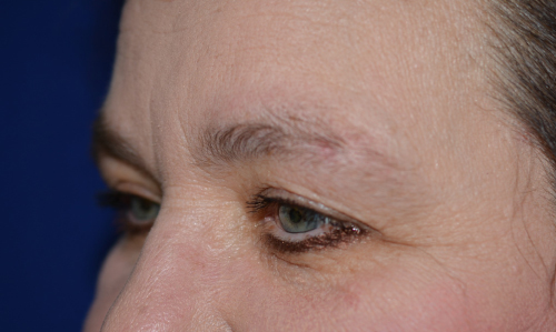 Before Eye Lid Lift with Dr Chatham