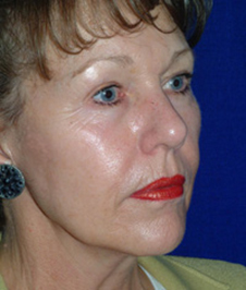 After Facelift Results with Dr Chatham