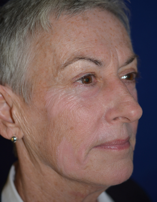 See More Before/After Filler Patients