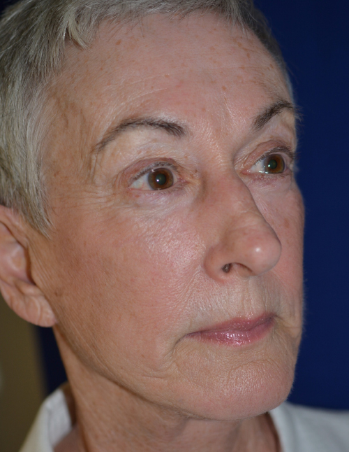 See More Before/After Filler Patients