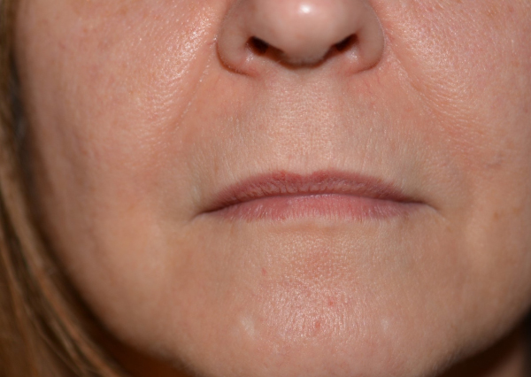 See More Before/After Filler Patients