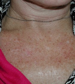 Before and After Laser and Light Skin Treatments
