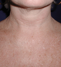 Before and After Laser and Light Skin Treatments
