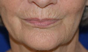 Before and After Laser and Light Skin Treatments
